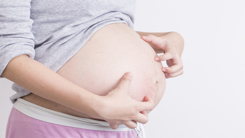 What is Intrahepatic Cholestasis of Pregnancy
